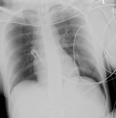 CXR 所描绘的气胸与 CT 所示一致