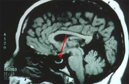 磁共振成像 (MRI) 矢状面的空泡蝶鞍