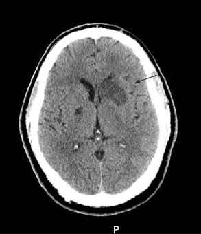 脑部非增强 CT 平扫表现为左基底神经节亚急性梗死，左侧前角有占位效应