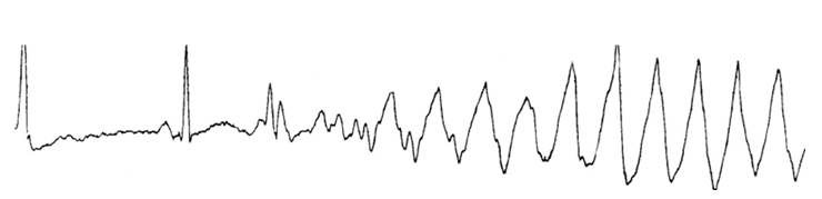 ECG 描记图显示一位有复发性晕厥及明显的长 QT 综合征患者出现尖端扭转型室性心动过速发作