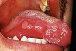 白塞病的口腔溃疡病损