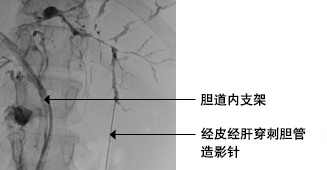 一个原发性硬化性胆管炎患者典型的ERCP表现：肝内外胆管多发狭窄