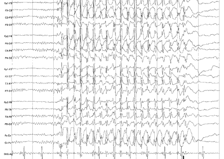 EEG 显示 3 Hz 广泛性棘慢波模式标志着典型失神发作和儿童失神性癫痫。