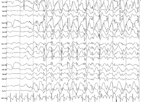 EEG 显示广泛性棘慢波 (＜ 2.5 Hz) 与非典型失神发作和 Lennox-Gastaut 综合征相关。