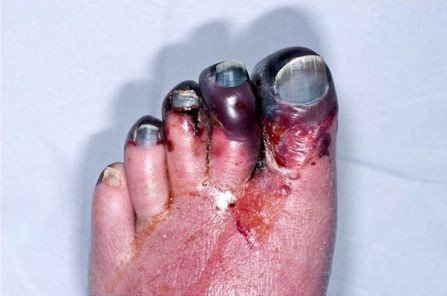 Venous 肝素诱导性血小板减少症中的左脚静脉肢体坏疽：（背侧）