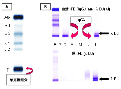 A：血清蛋白电泳显示 M 蛋白。B：血清和尿免疫固定电泳