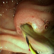 Endoscopic photo of same patient following removal of large common bile duct (CBD) stone; note copious pus draining through the ampulla