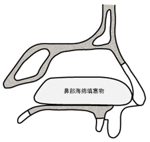 扩张型鼻部海绵填塞到位