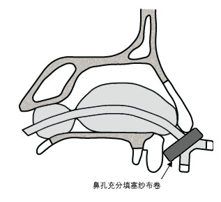 双气囊鼻导管放置到位