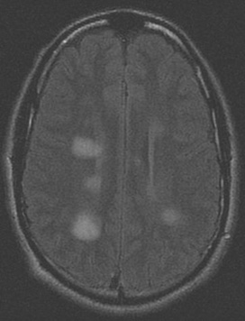 急性播散性脑脊髓炎患者脑部 MRI 扫描系列图像：脑室周围