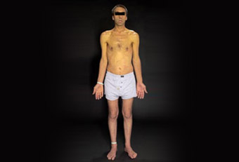 黄疸成人患者
