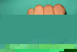 拇指征阳性