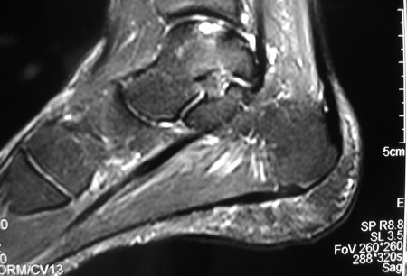 距骨的矢状磁共振成像 (MRI) 显示距骨穹隆后面的骨软骨病变