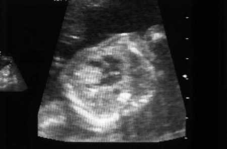矢状 T1 MRI 检查显示心脏横纹肌瘤