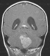 MRI：髓母细胞瘤冠状位观图、采用钆增强的 T1WI，显示明显强化的实质性和囊性病变填充第四脑室；出现梗阻性脑积水。