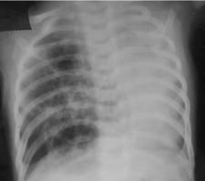 先天性肺气道畸形（congenital pulmonary airway malformation, CPAM；以前被称为先天性肺囊腺瘤样畸形 [congenital cystic adenomatoid malformation, CCAM]）