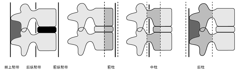 Denis三柱理论的表格概要
