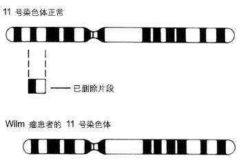 11 号染色体缺失